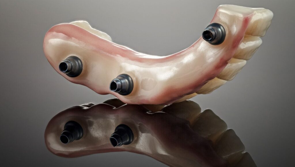 dental-overdenture-with-implants-on-reflective-surf