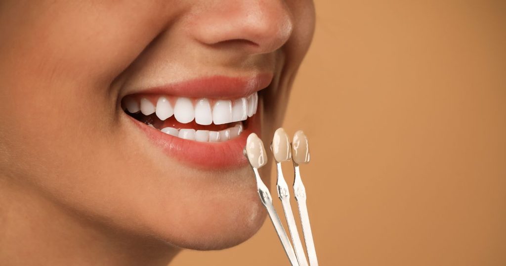 Porcelain veneers in City Clinic Dental Marbella
