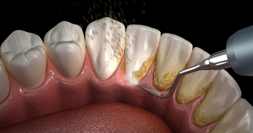 Diferencia entre la placa y el sarro en los dientes